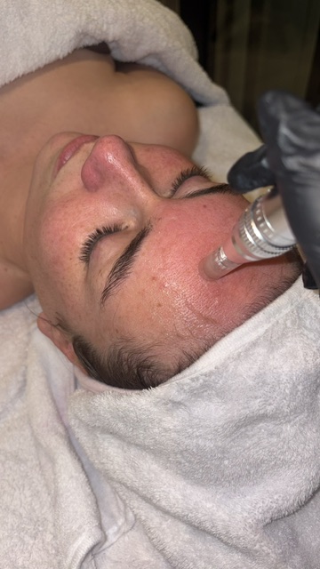 Dermapen behandeling van het gezicht