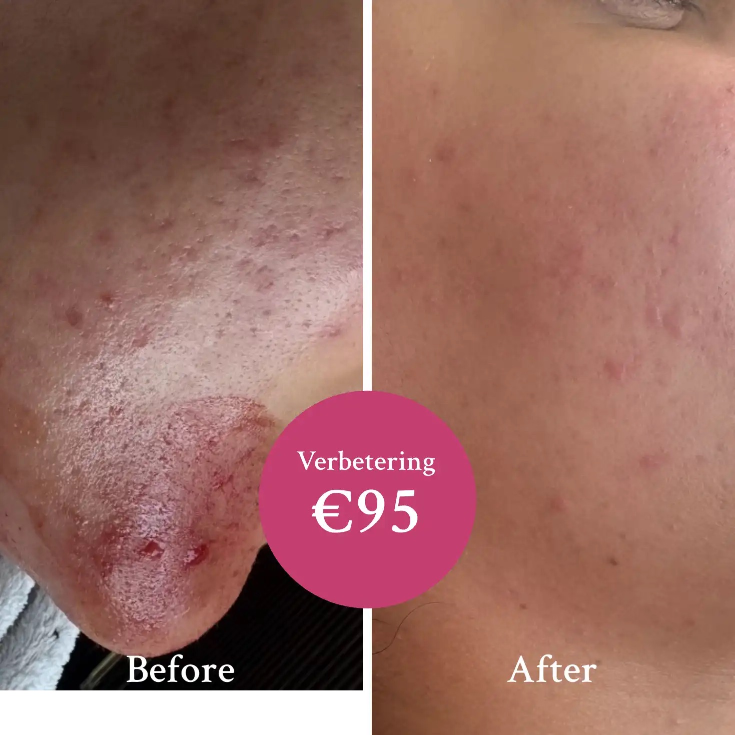 Huidverbetering bij acne, voor en na de behandeling